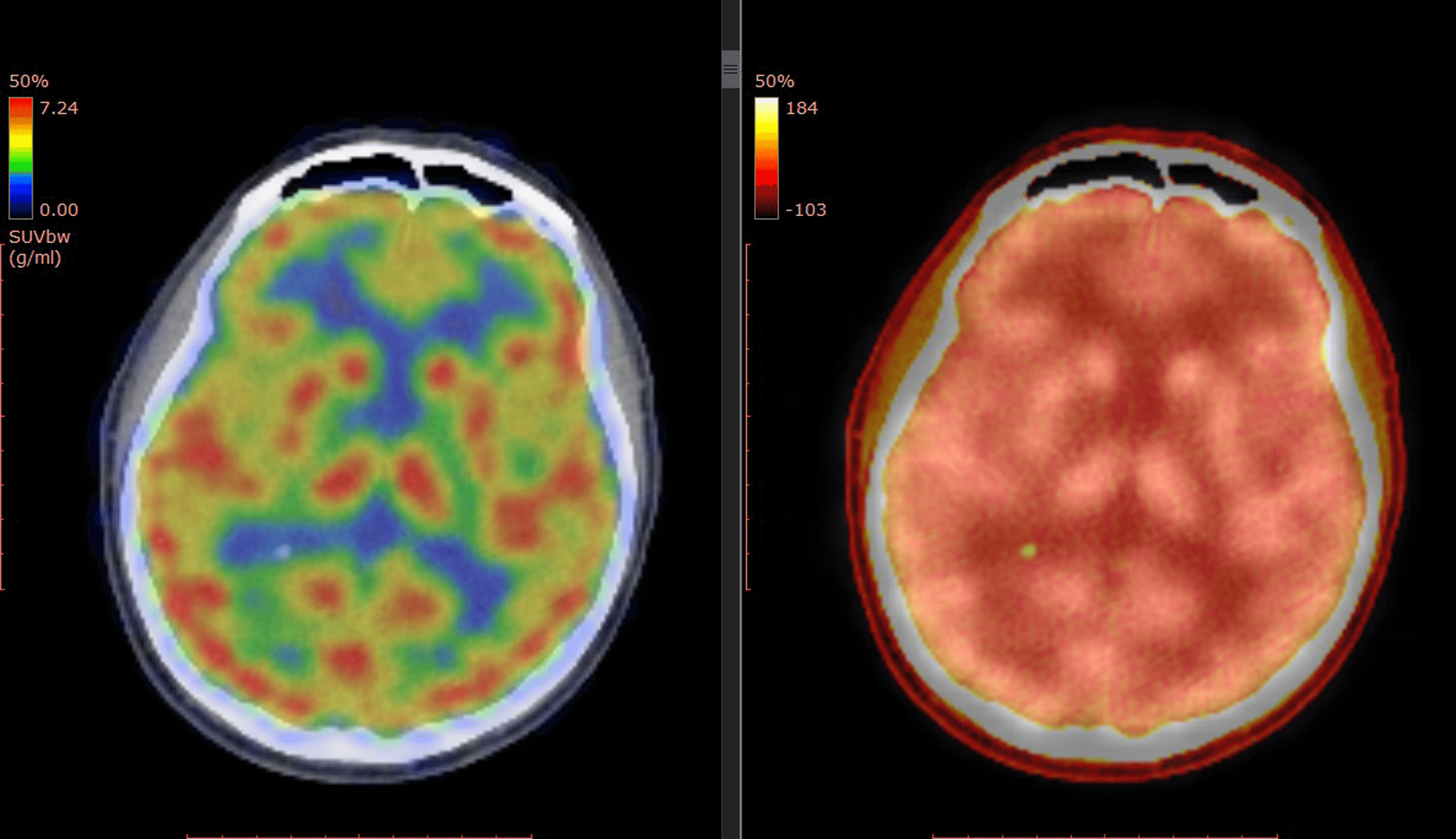 side by side PET scan images